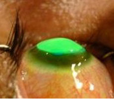 Διασύνδεση κερατοειδούς