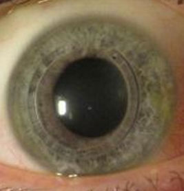 Ενδοκερατικοί δακτύλιοι