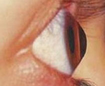 Κερατόκωνος