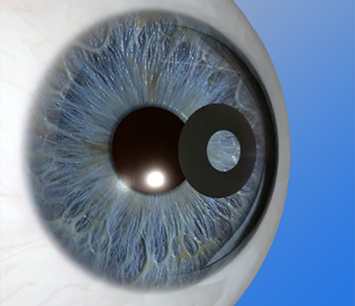 Ενδοκερατικά Ενθέματα