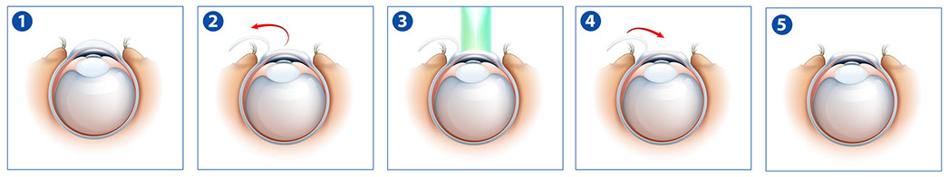 Laser Lasik Laser Lasik