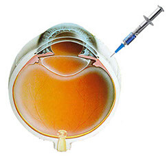 Ενδοβολβικές ενέσεις