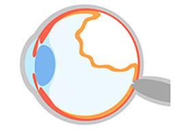 Αποκόλληση Υαλοειδούς